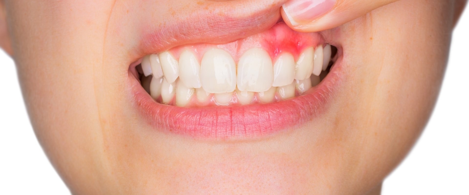 How do you know if your gums are damaged?