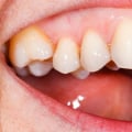 What do normal gums feel like?