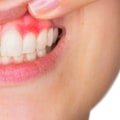 How do you know if your gums are damaged?