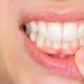 Can gum health be restored?