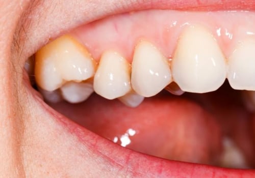 What do normal gums feel like?