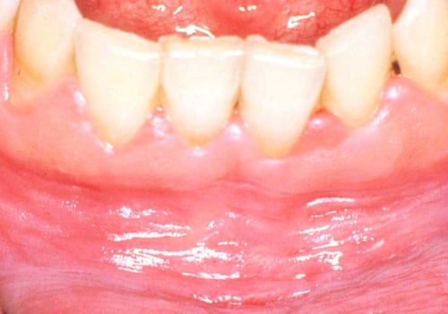 What do unhealthy gums feel like?